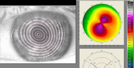 Keratokonus Kontaktlinsenspezialist Optometrie Gleitsichtbrillen 